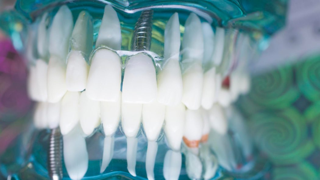 Comment retrouver confiance en son sourire grâce aux implants dentaires ?