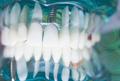 Comment retrouver confiance en son sourire grâce aux implants dentaires ?